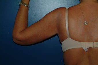 Brachioplasty 575815