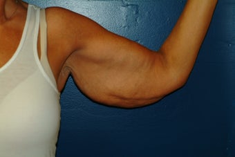 Brachioplasty before 575815