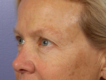 Eyelid Surgery before 280870