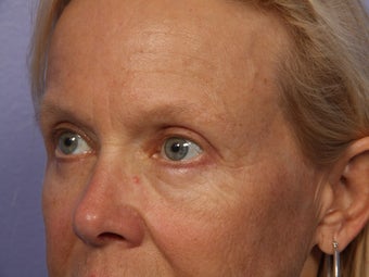 Eyelid Surgery after 280870