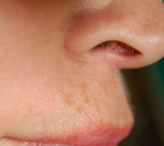 Botox after 1018220