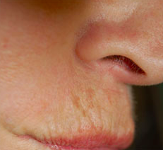 Botox before 1018220
