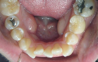 Invisalign 372757