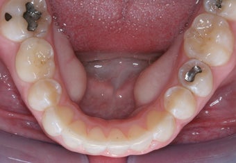 Invisalign 372757