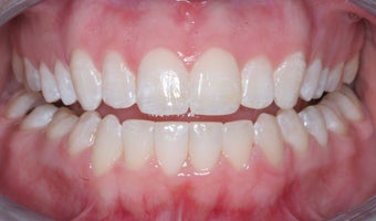 Invisalign after 372757