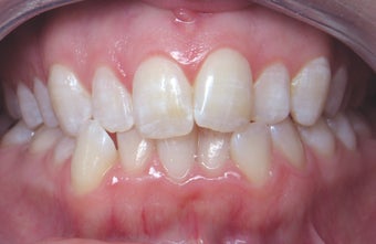 Invisalign before 372757
