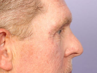 Eyelid Surgery after 280850