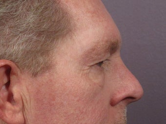 Eyelid Surgery before 280850