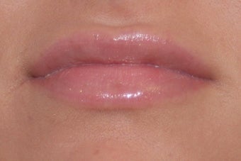 Lip Enhancement after 1058431
