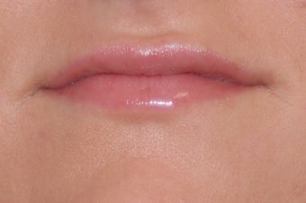 Lip Enhancement before 1058431