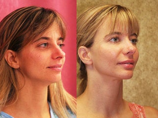 facial fat grafting after 232501