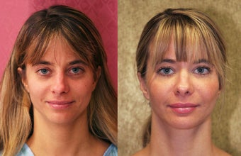 facial fat grafting before 232501