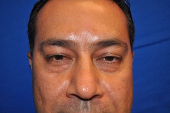 43 Year Old Male treated with Lower Eyelid Surgery to remove Puffy Eye Bags before 894614