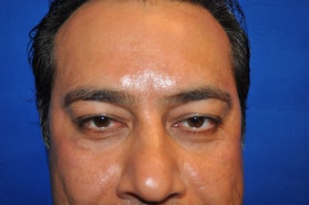 43 Year Old Male treated with Lower Eyelid Surgery to remove Puffy Eye Bags after 894614