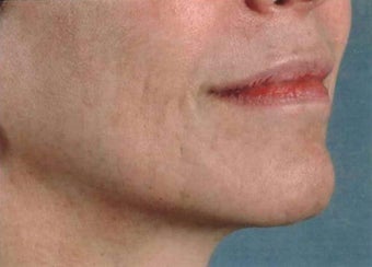 Facial Correction with filler after 1123915