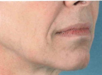 Facial Correction with filler before 1123915