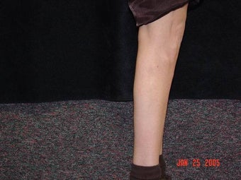 Calf Implants 692838