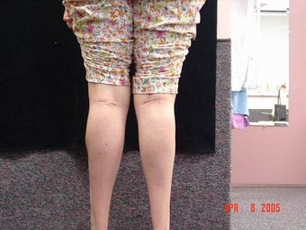 Calf Implants after 692838