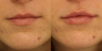 Lip Augmentation before 910731
