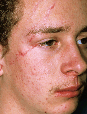 Scar Revision before 906273