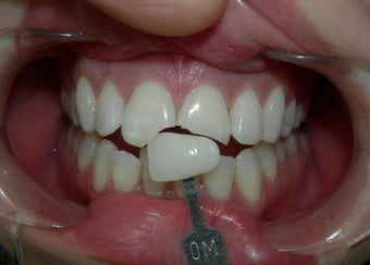 Porcelain Crowns 887688