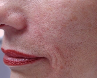 Filler - Nasal Folds after 221452