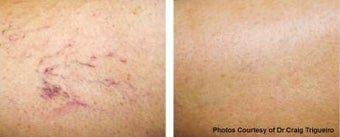 Vbeam vein removal before 369210