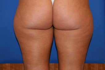 Smartlipo treatment to inner and outer thighs 1361277