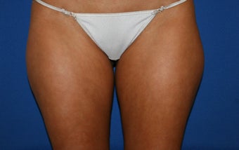 Smartlipo treatment to inner and outer thighs before 1361277