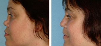 Functional Rhinoplasty before 1208301