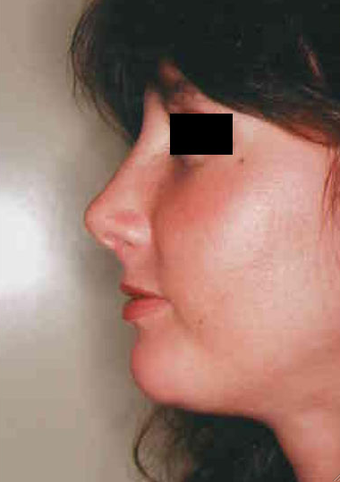 Revision Rhinoplasty after 665078