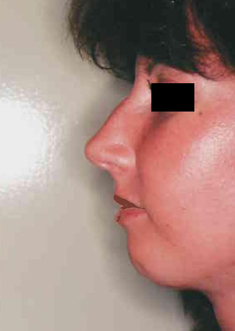 Revision Rhinoplasty before 665078