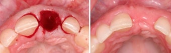 Extraction and Graft before 957148