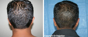 Ear Surgery before 1245314