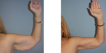Arm Lift before 1153908