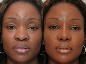 African American Rhinoplasty before 44105