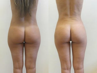 Brazilian butt lift after 221056