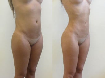 Brazilian butt lift before 221056
