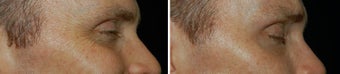 Botox for Crows Feet before 97869