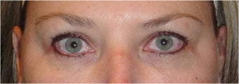 Restylane after 686389