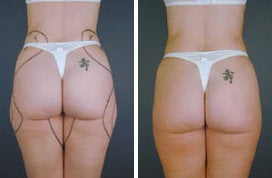 Tumescent Liposuction before 349930