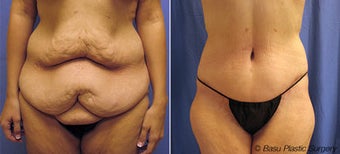 Body Lift before 270846