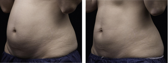 liposonix before 511481