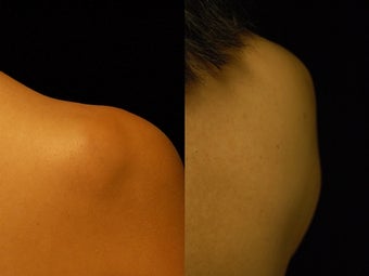 44 year-old Woman Treated for Lipoma on Right Upper Back after 837426
