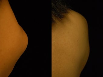 44 year-old Woman Treated for Lipoma on Right Upper Back 837426