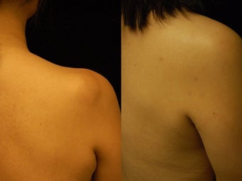 44 year-old Woman Treated for Lipoma on Right Upper Back before 837426
