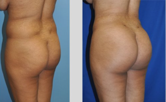 Buttock Augmentation before 271480