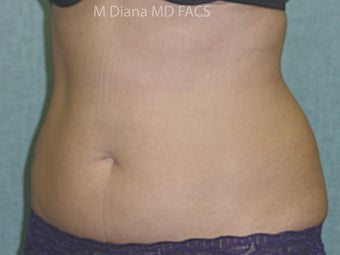 SmartLipo before 607529