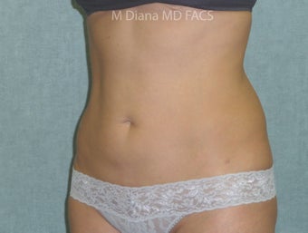 SmartLipo after 607529