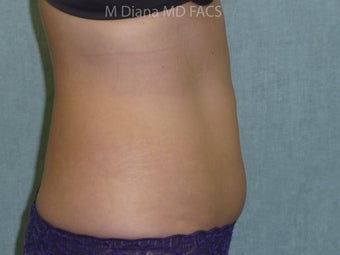 SmartLipo 607529